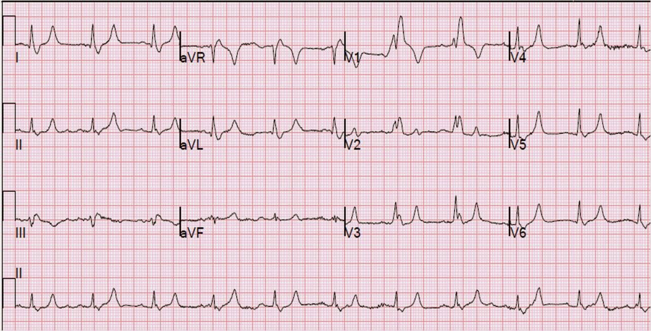 bundle-branch-block-causes-symptoms-diagnosis-treatment