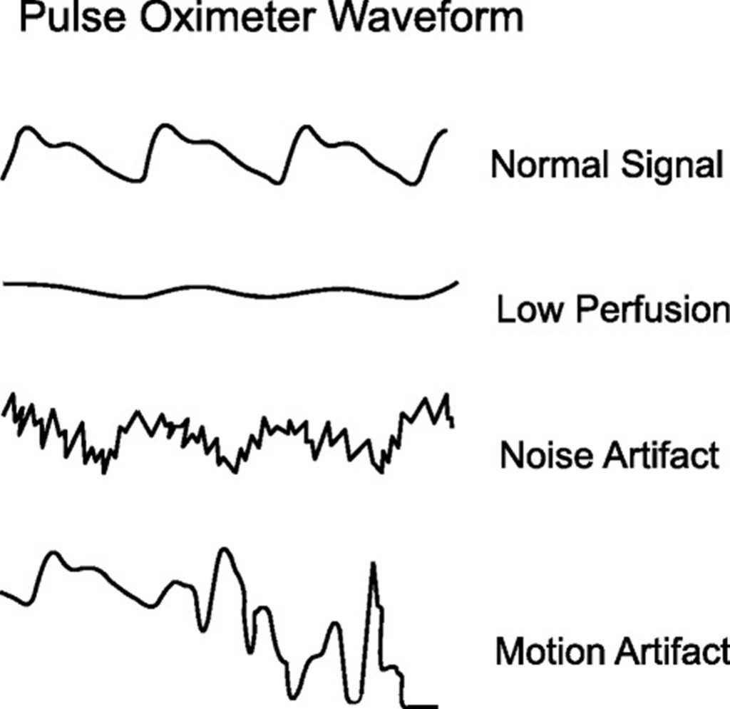 Pulse Oximeter What Pulse Oximeter Measure, Normal Range