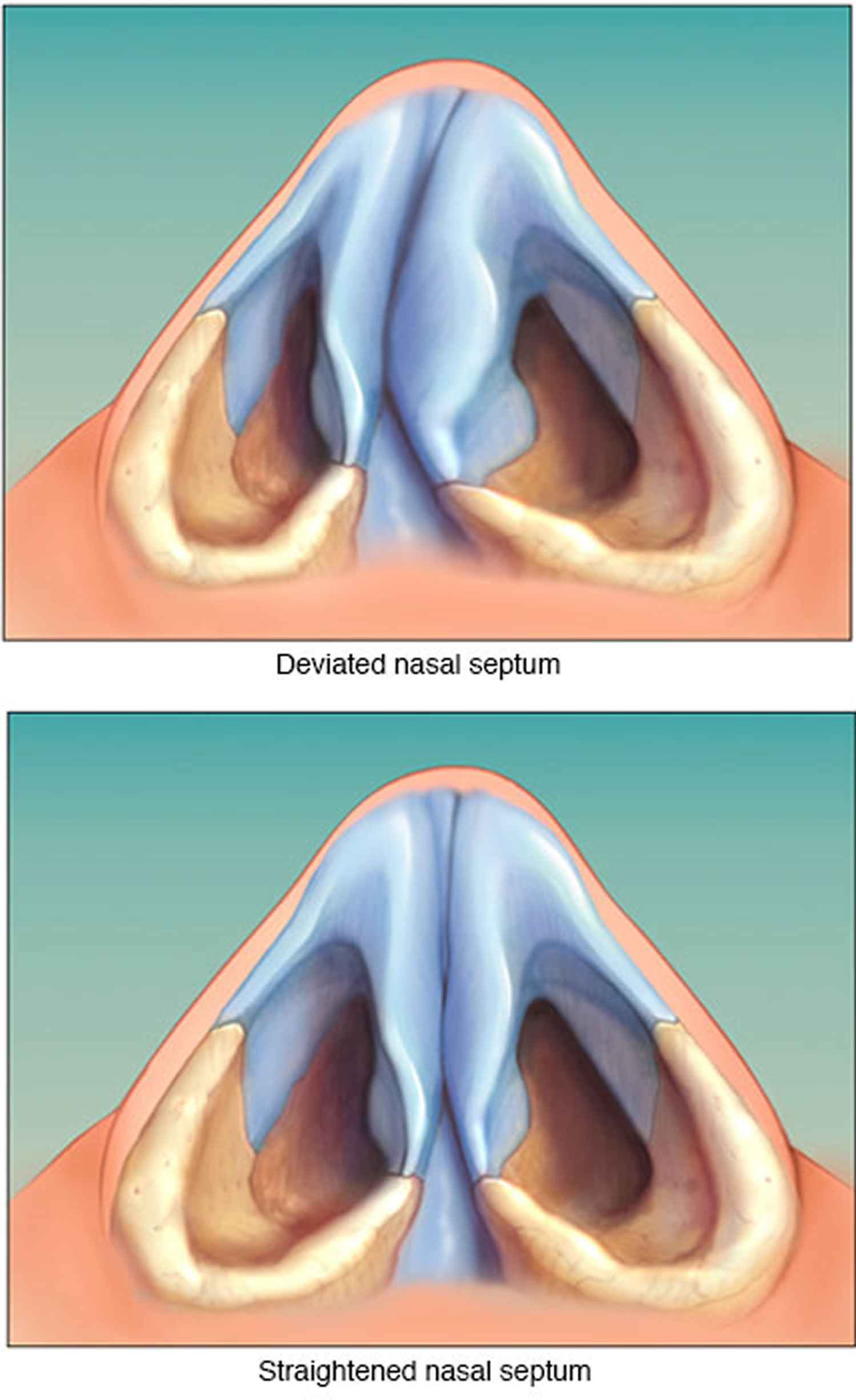 Septoplasty Surgery Recovery Time And Complications