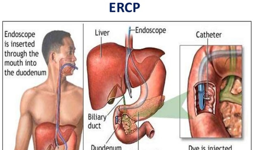 ERCP – Endoscopic retrograde cholangiopancreatography