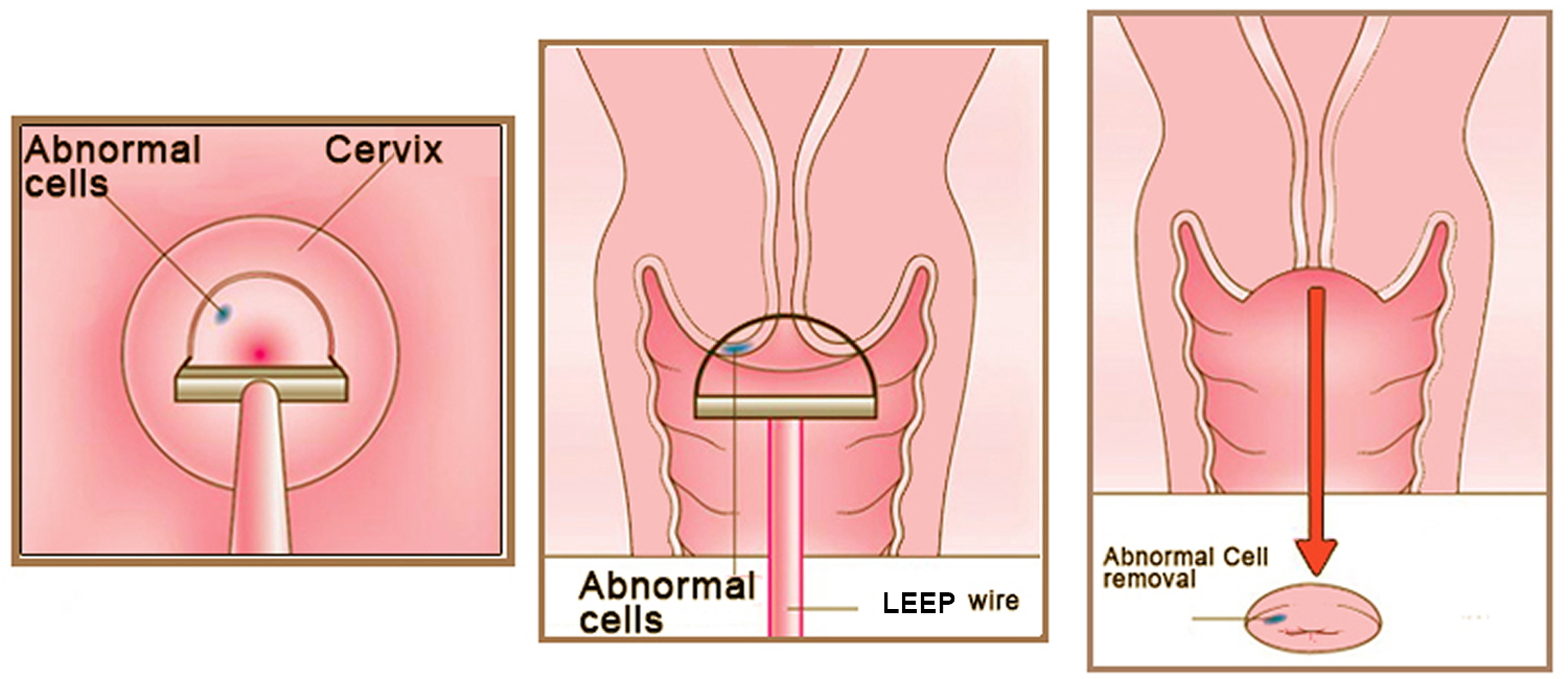 Tests for women with symptoms of cervical cancer or abnormal Pap smear test...
