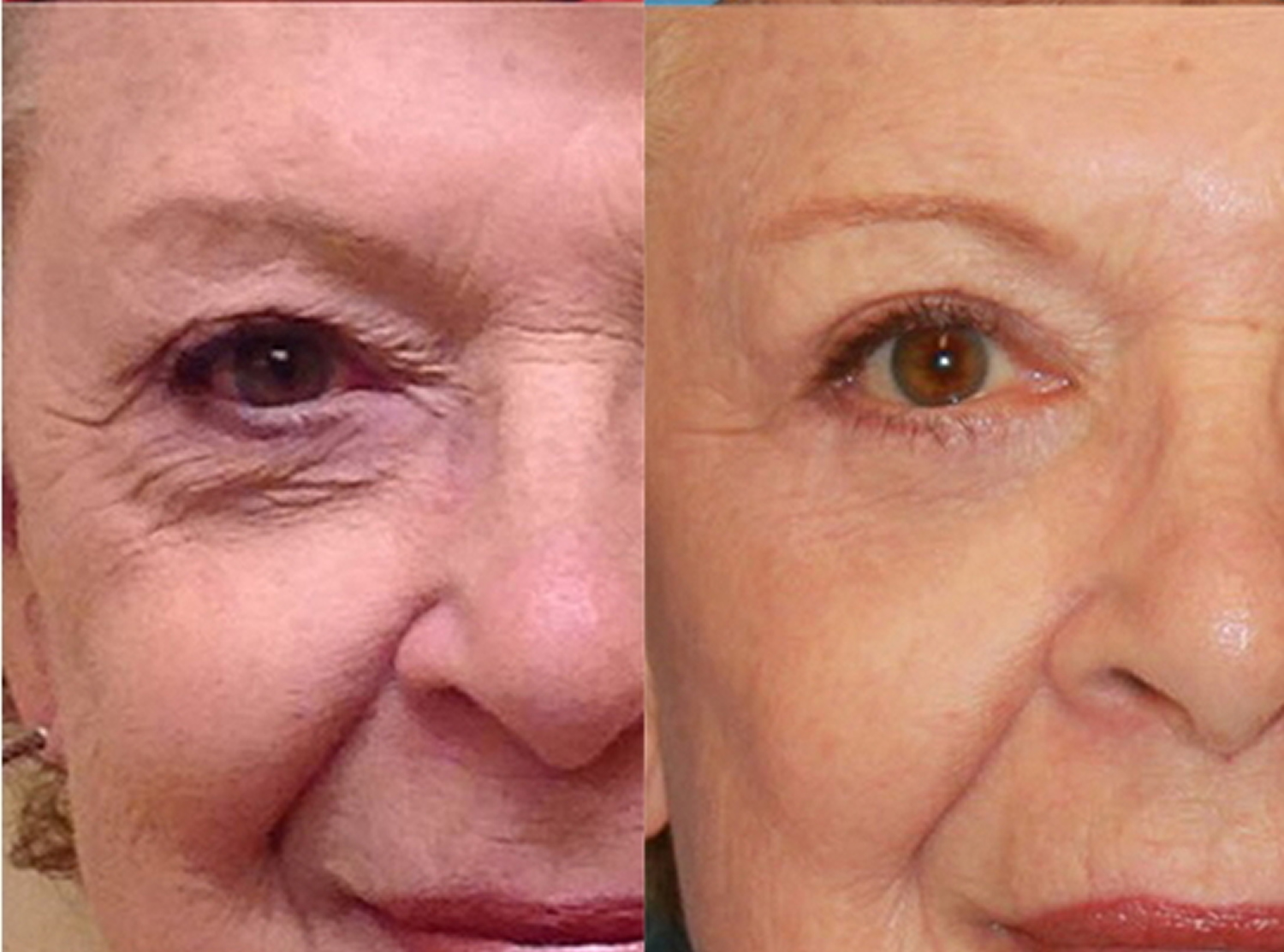 Eyelid Surgery Upper And Lower Blepharoplasty Surgery Recovery 3996