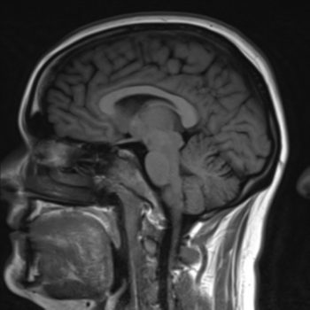 CT Scan - CAT Scan, Machine, Uses, Prep, Side Effects