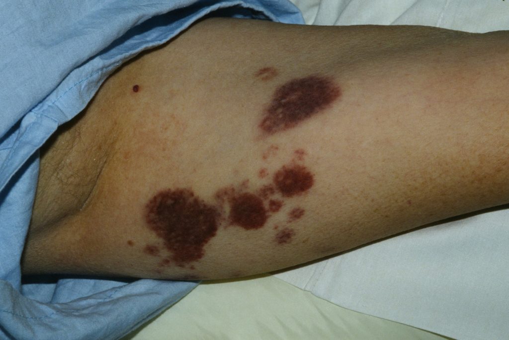 pinpoint red dots on skin turn brown platelets