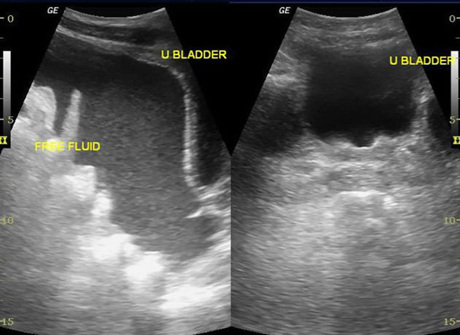 Paracentesis Procedure - Abdominal Paracentesis Position, Complications