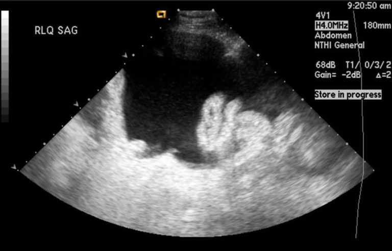 Paracentesis Procedure - Abdominal Paracentesis Position, Complications
