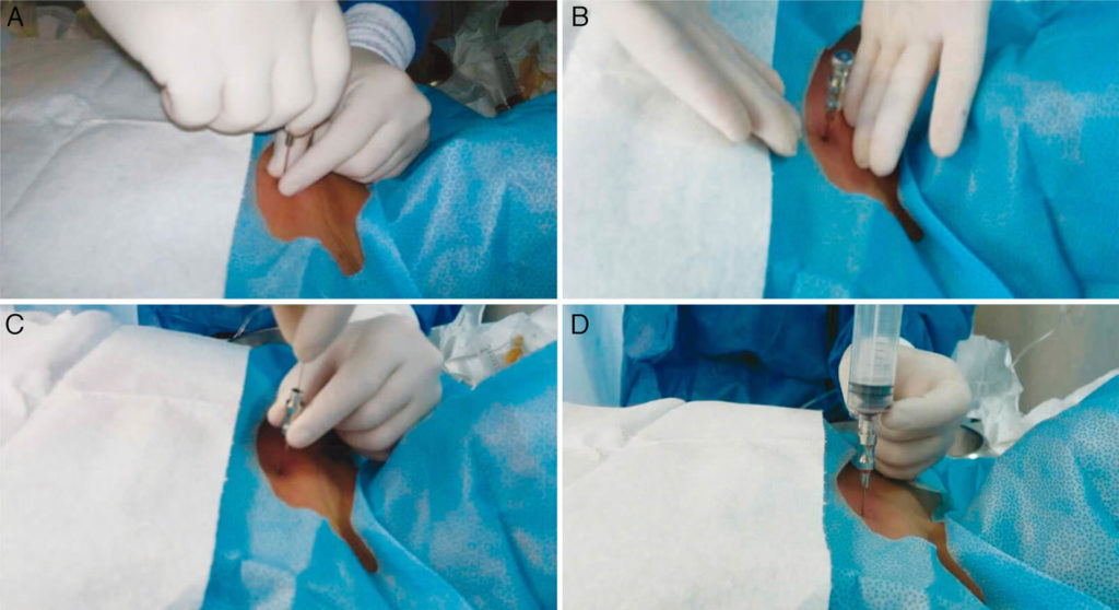 Bone Marrow Biopsy - Reasons, Pain, Complications