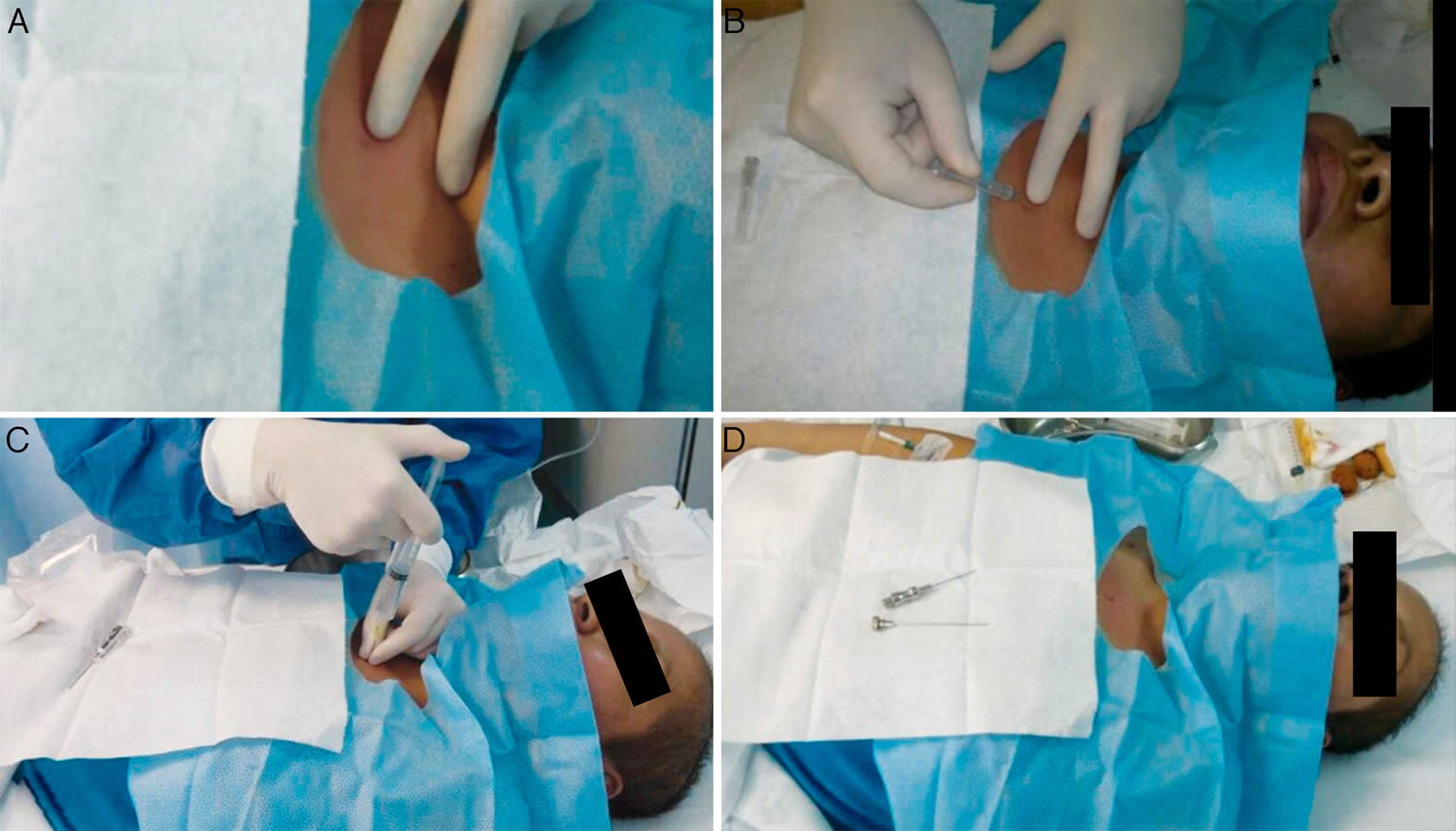 Bone Marrow Biopsy Reasons Pain Complications bone-marrow-biopsy-reasons-pain-complications