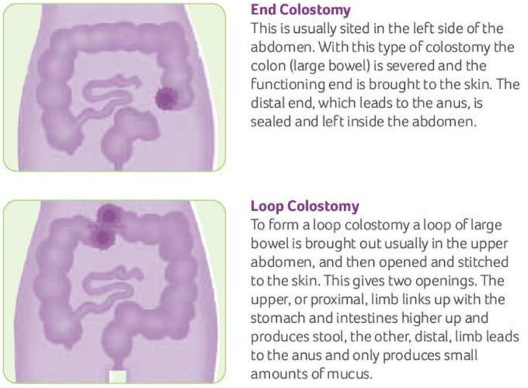 Colostomy How To Change A Colostomy Bag & Living With It