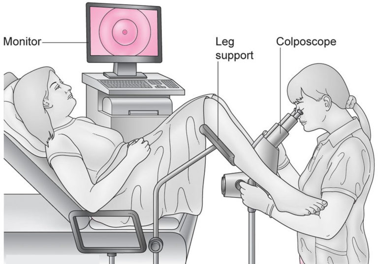 Colposcopy Colposcopy Biopsy Results Hpv Side Effects 