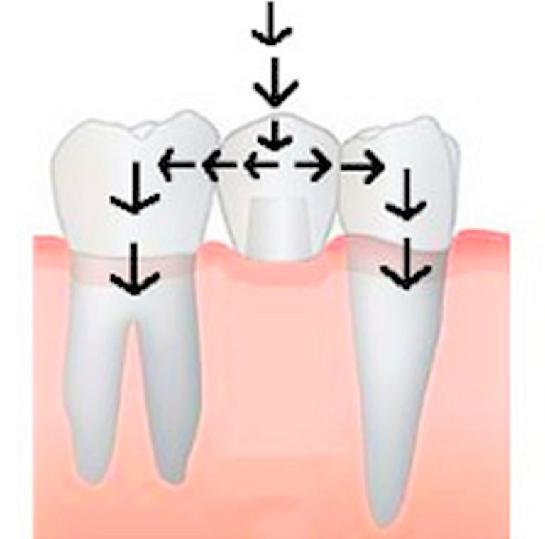 Dental Bridge Procedure, Dental Bridge Vs Dental Implant