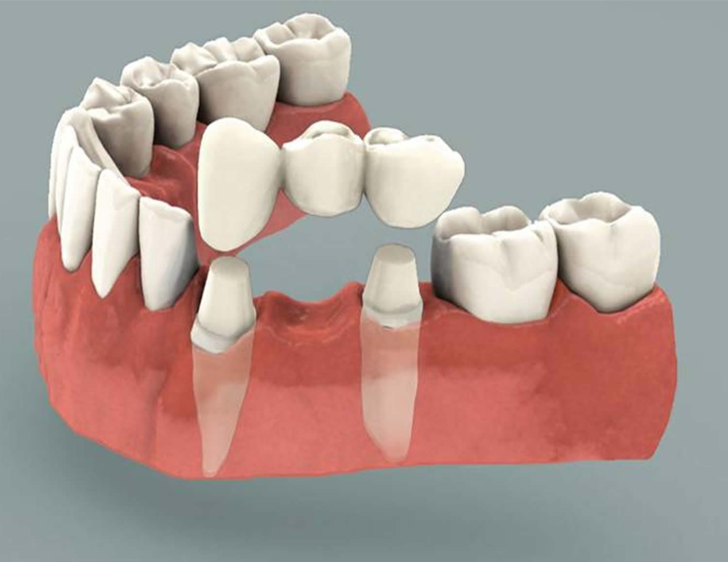 Dental Bridge - Procedure, Dental Bridge Vs Dental Implant