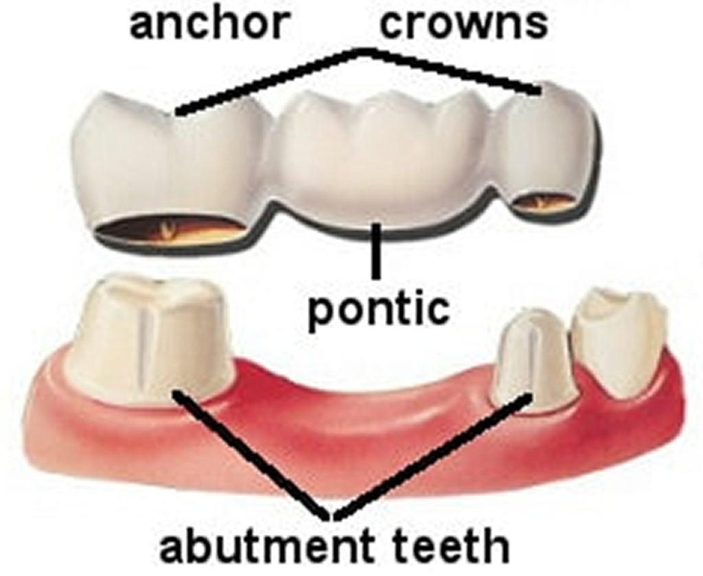 Dental Bridge Procedure, Dental Bridge Vs Dental Implant