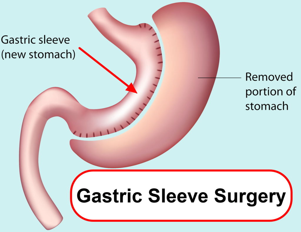 Gastrectomy Types, Post Gastrectomy Diet And Life After Total Gastrectomy