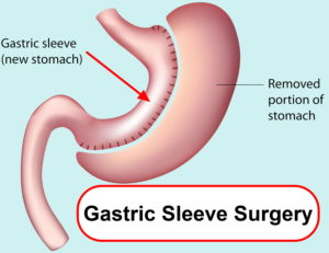 Gastrectomy types, post gastrectomy diet and life after total gastrectomy