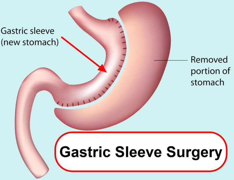 Gastrectomy types, post gastrectomy diet and life after total gastrectomy