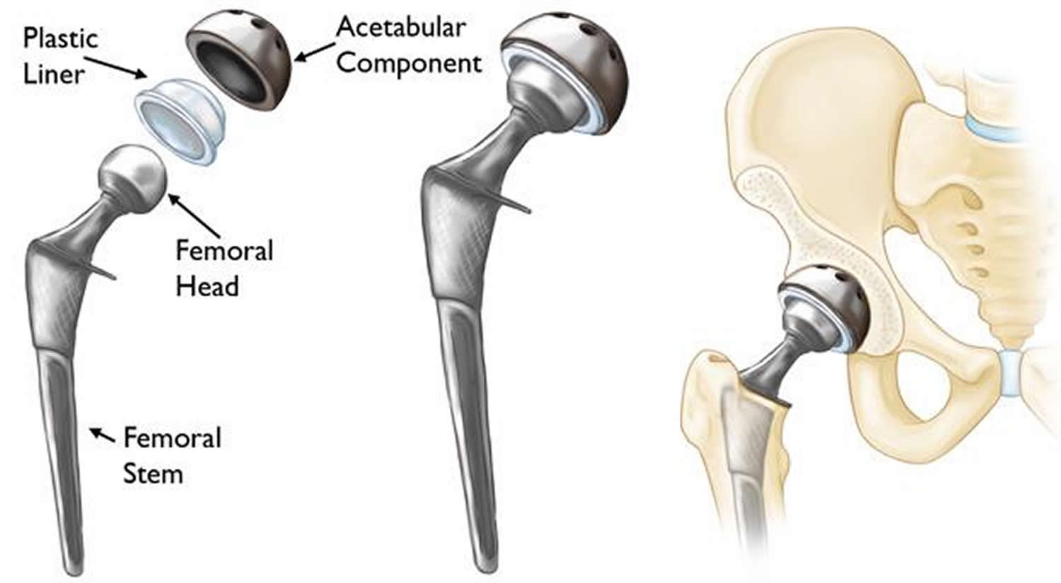 Hip Replacement Surgery Recovery Time, Alternatives, Risks