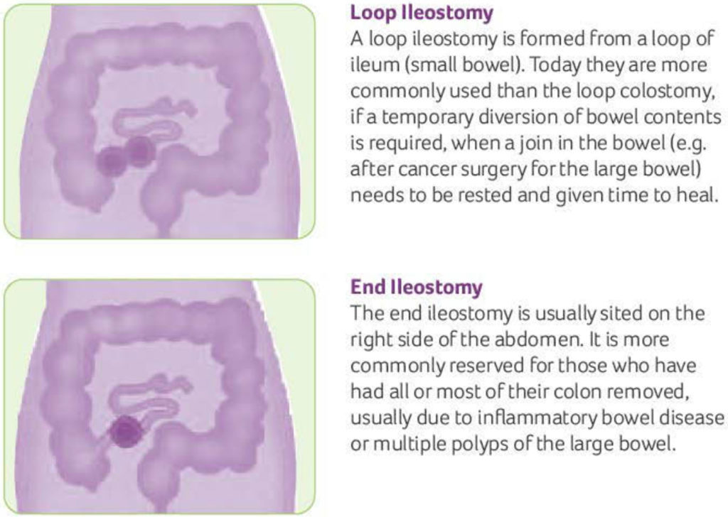 Loop Ileostomy Anatomy