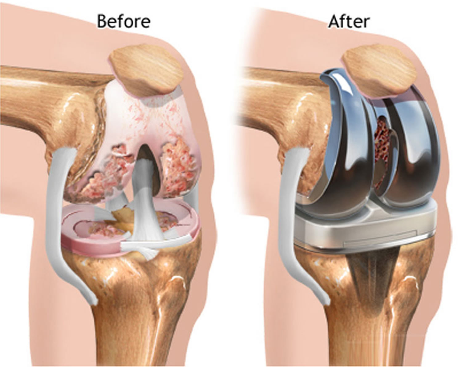 Артроз коленного сустава мениск. Эндопротез коленного сустава. Эндопротезирование сустава ВНЧС. Артрит коленного сустава операция. Имплант ПКС коленного сустава.