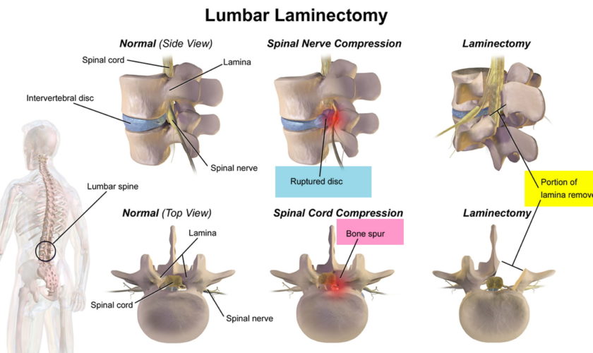 laminectomy