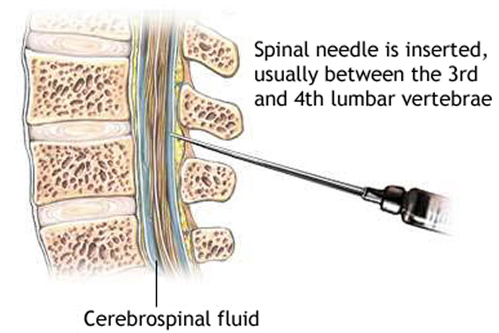 Lumbar Puncture Procedure Position And Lumbar Puncture Side Effects 8629