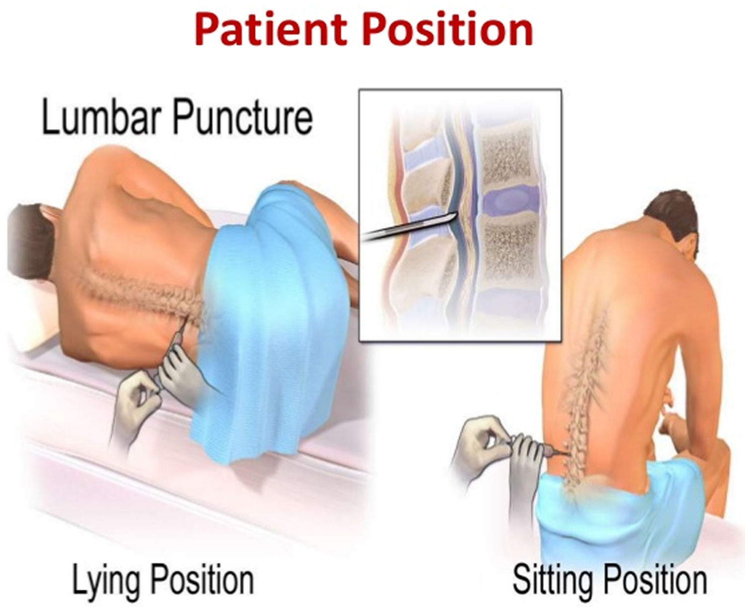 Lumbar Puncture Procedure - Position & Lumbar Puncture Side Effects With Lumbar Puncture Procedure Note Template