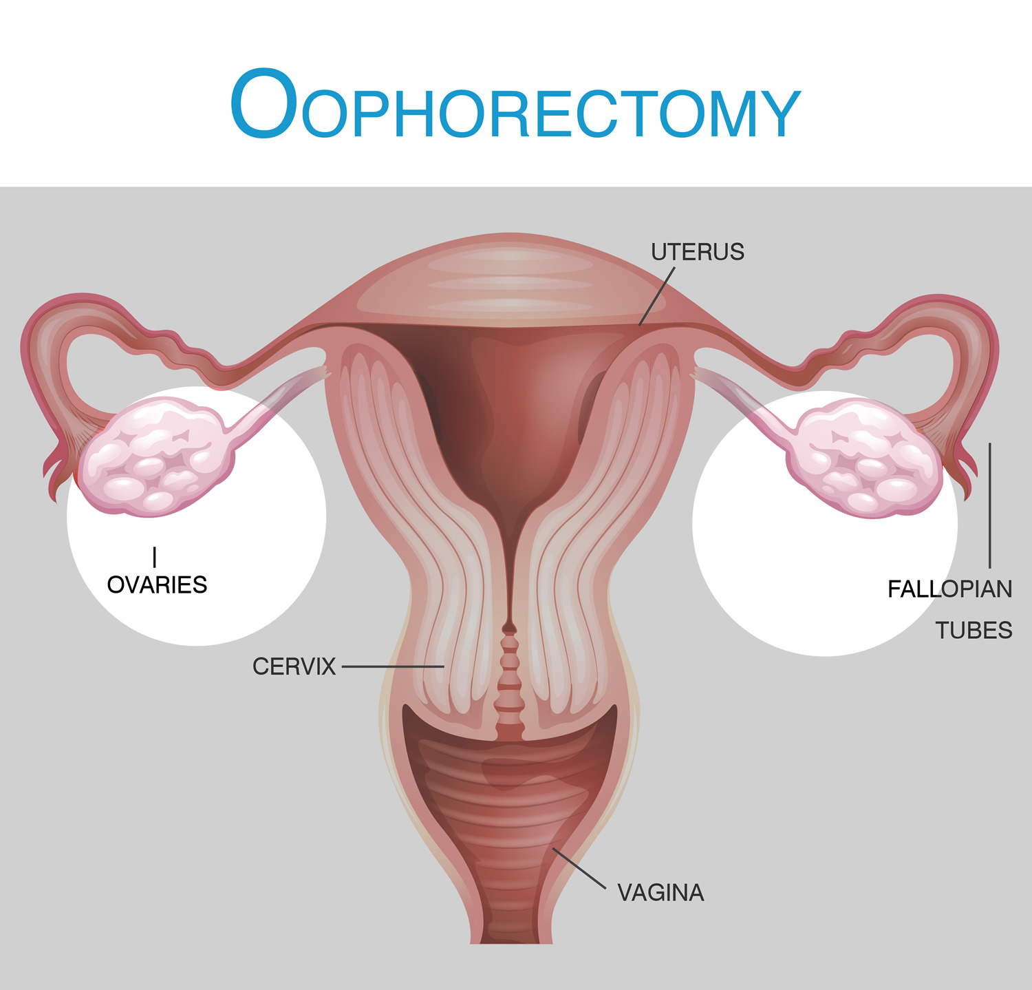 Oophorectomy Ovary Removal Surgery Salpingo Oophorectomy