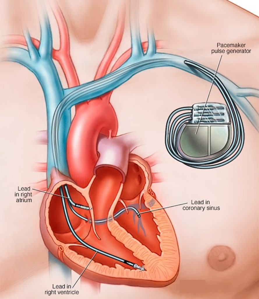 pacemaker-heart-pacemaker-indications-how-a-pacemaker-work