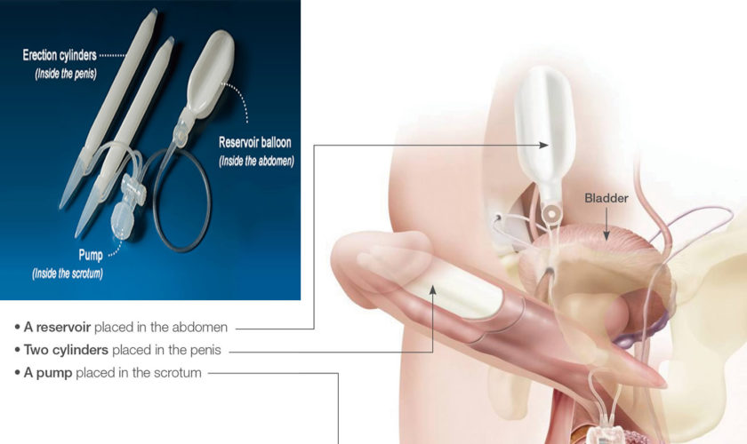 penile prosthesis implant