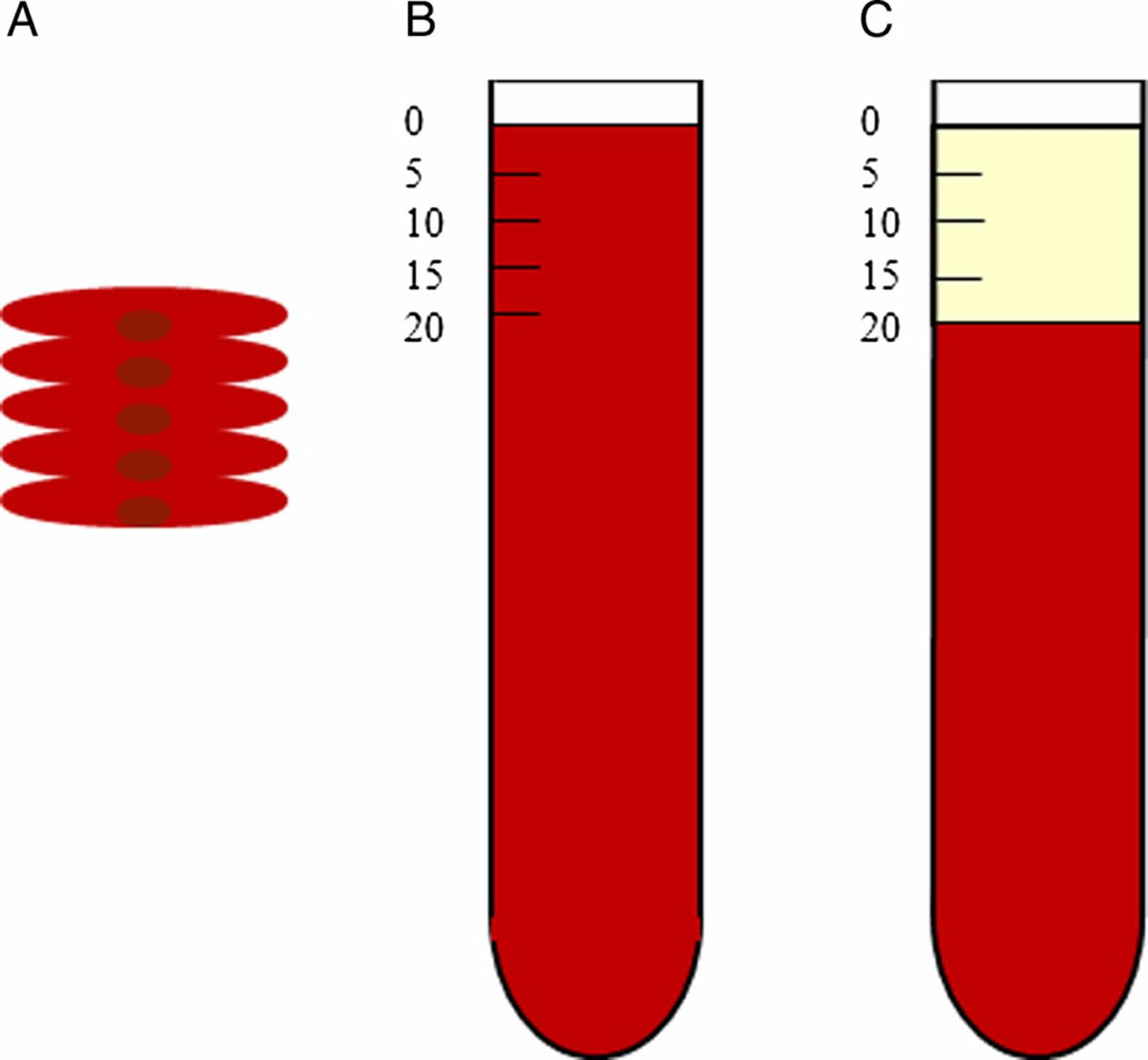 What Is Erythrocyte Sedimentation Rate In Blood Test