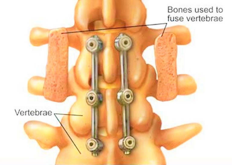 Laminectomy Surgery Recovery And Laminectomy Complications