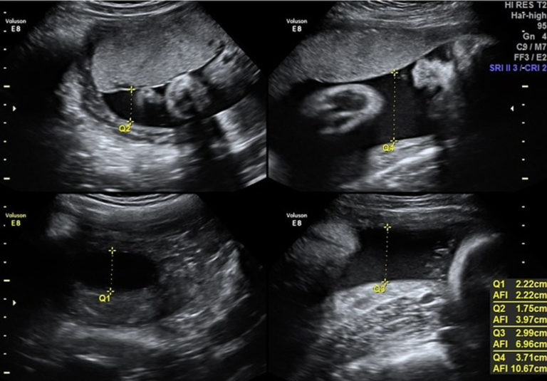 low amniotic fluid at 36 weeks pregnant