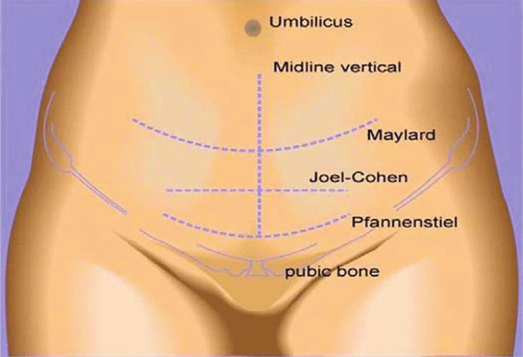 Cesarean Section Procedure Recovery Complications