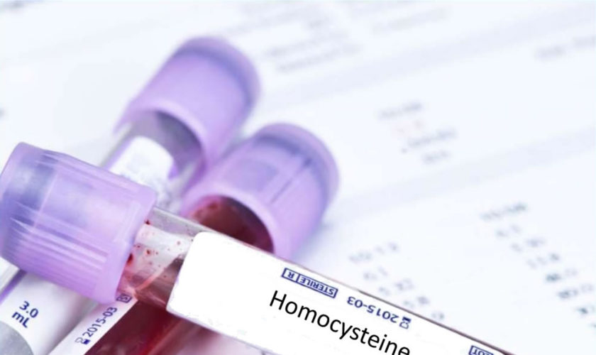 Homocysteine test