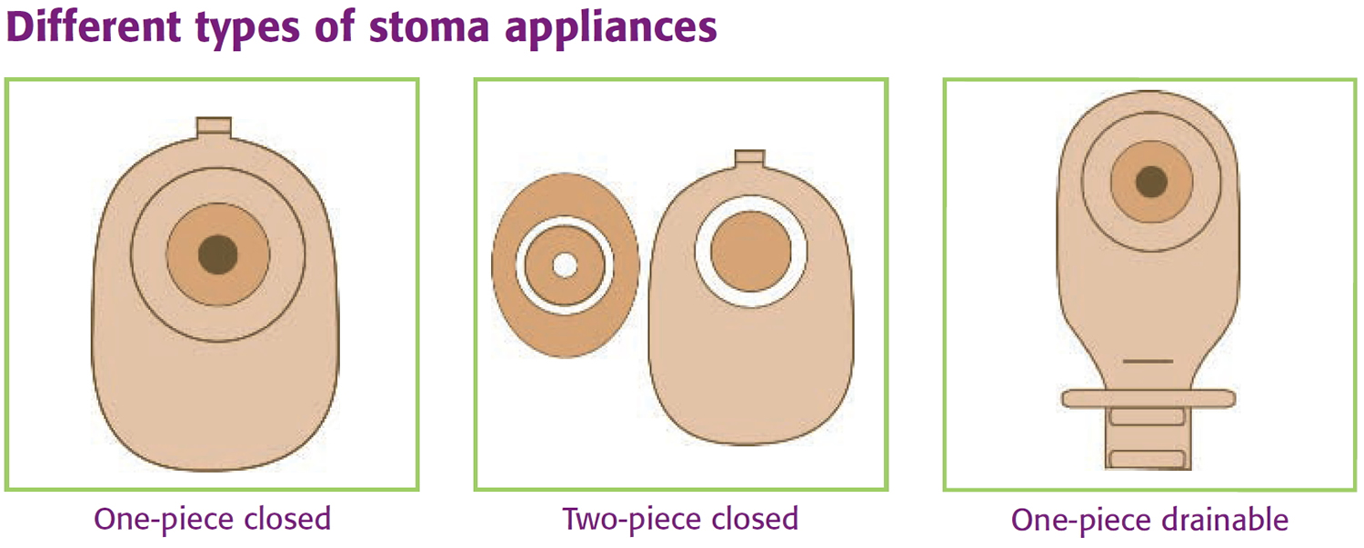 Ileostomy - Loop Ileostomy, End Ileostomy, Diet, Complications