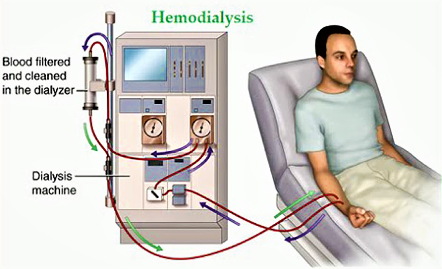 Hemodialysis Machine Diagram