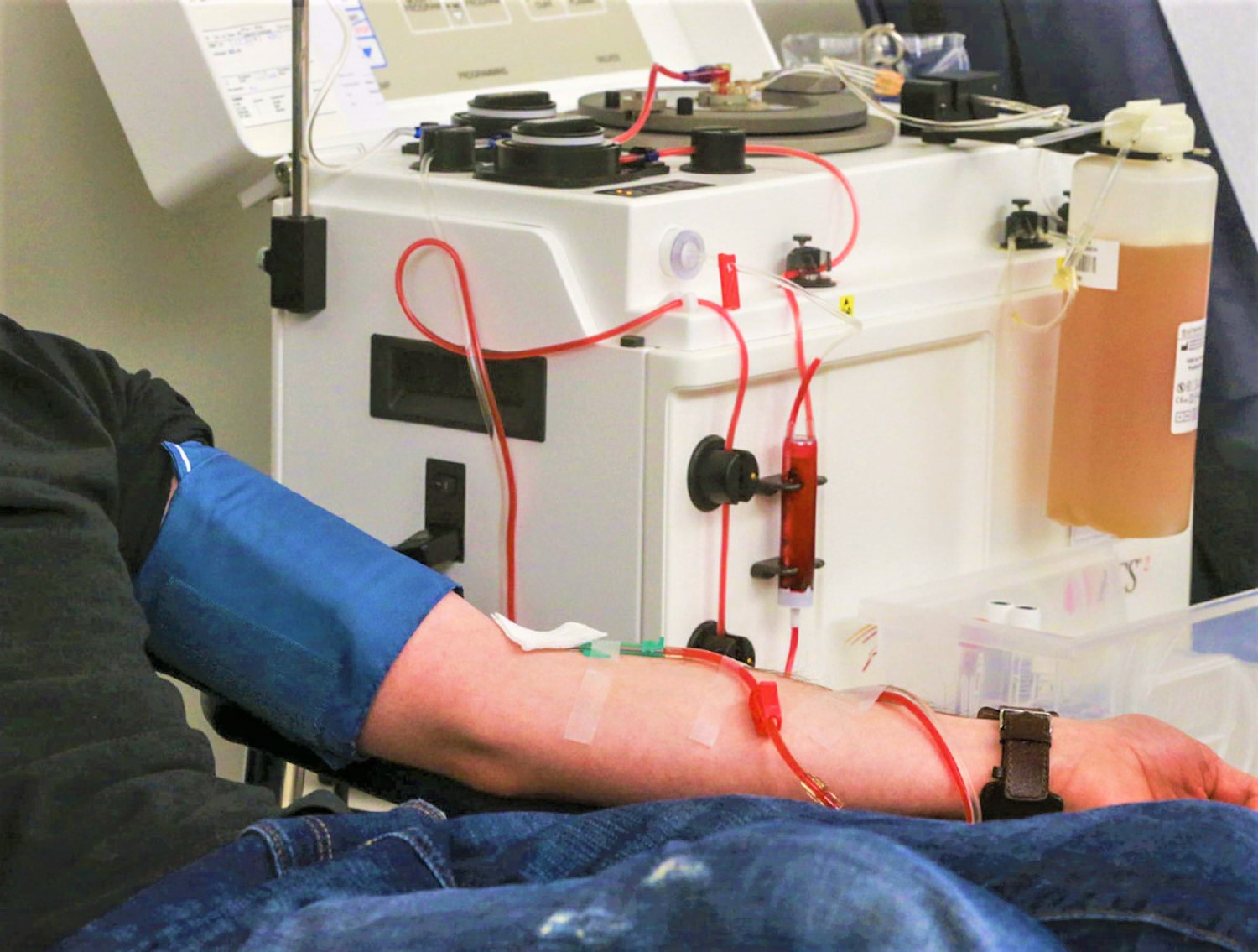 plasmapheresis-indications-plasmapheresis-side-effects