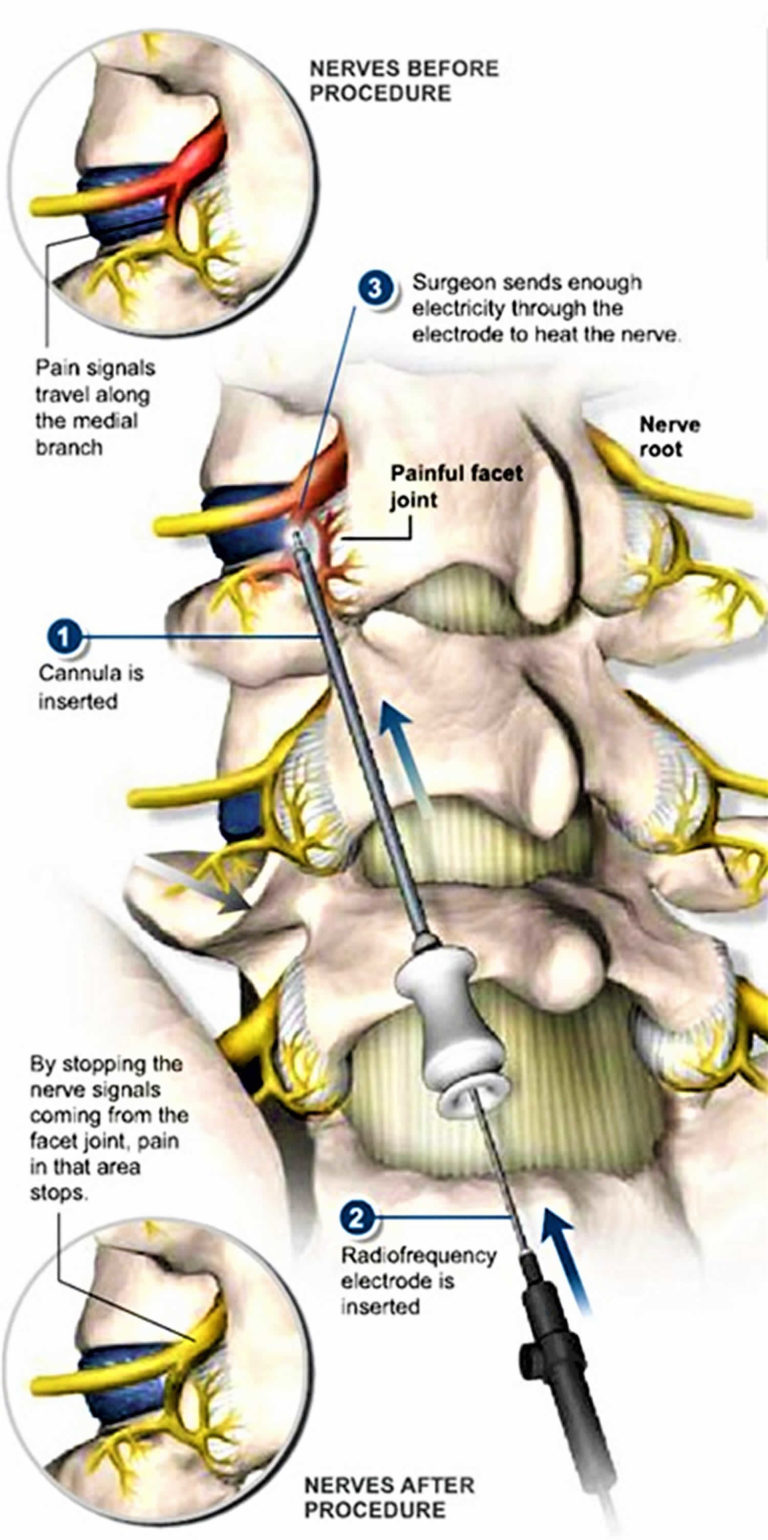 Radiofrequency Ablation - Lumbar Radiofrequency Ablation, Success Rate