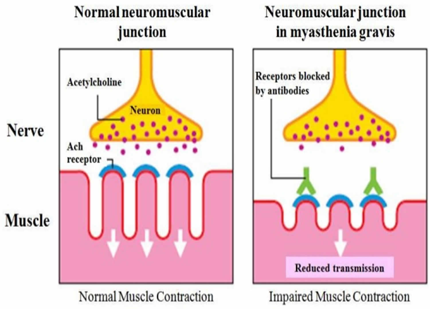 Acetylcholine Function Acetylcholine Deficiency Receptor Antibody