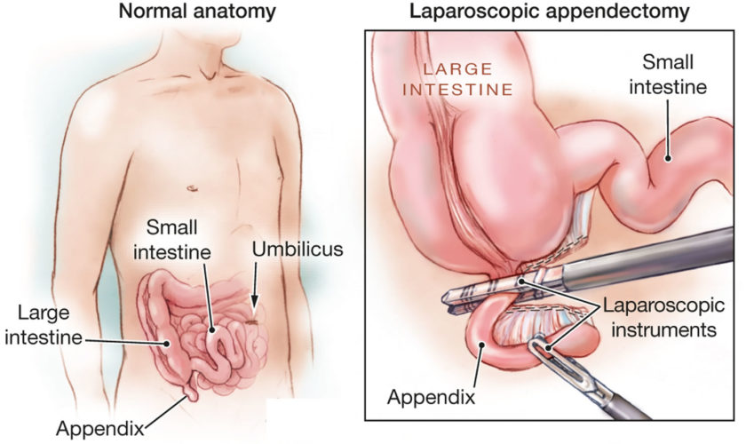 laparoscopic appendectomy