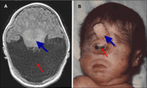 Holoprosencephaly Causes Diagnosis Prognosis And Treatment   Alobar Holoprosencephaly 300x181 