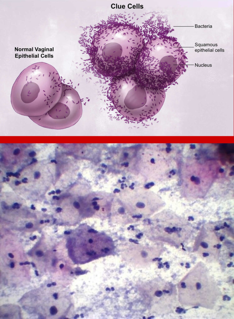 Bacterial Vaginosis Causes Symptoms Diagnosis And Bacterial Vaginosis Treatment 6060