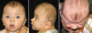 Craniosynostosis causes, symptoms, treatment & craniosynostosis surgery