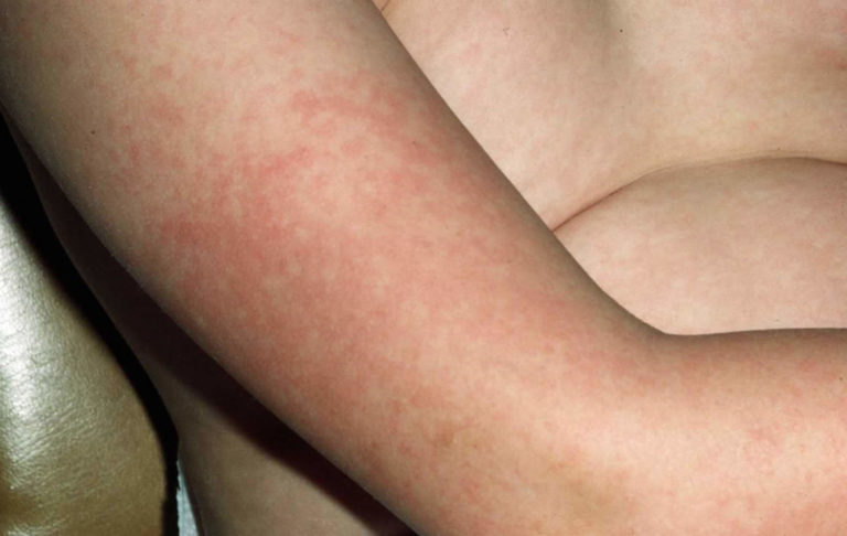 Fifth disease adult symptoms — pic 5
