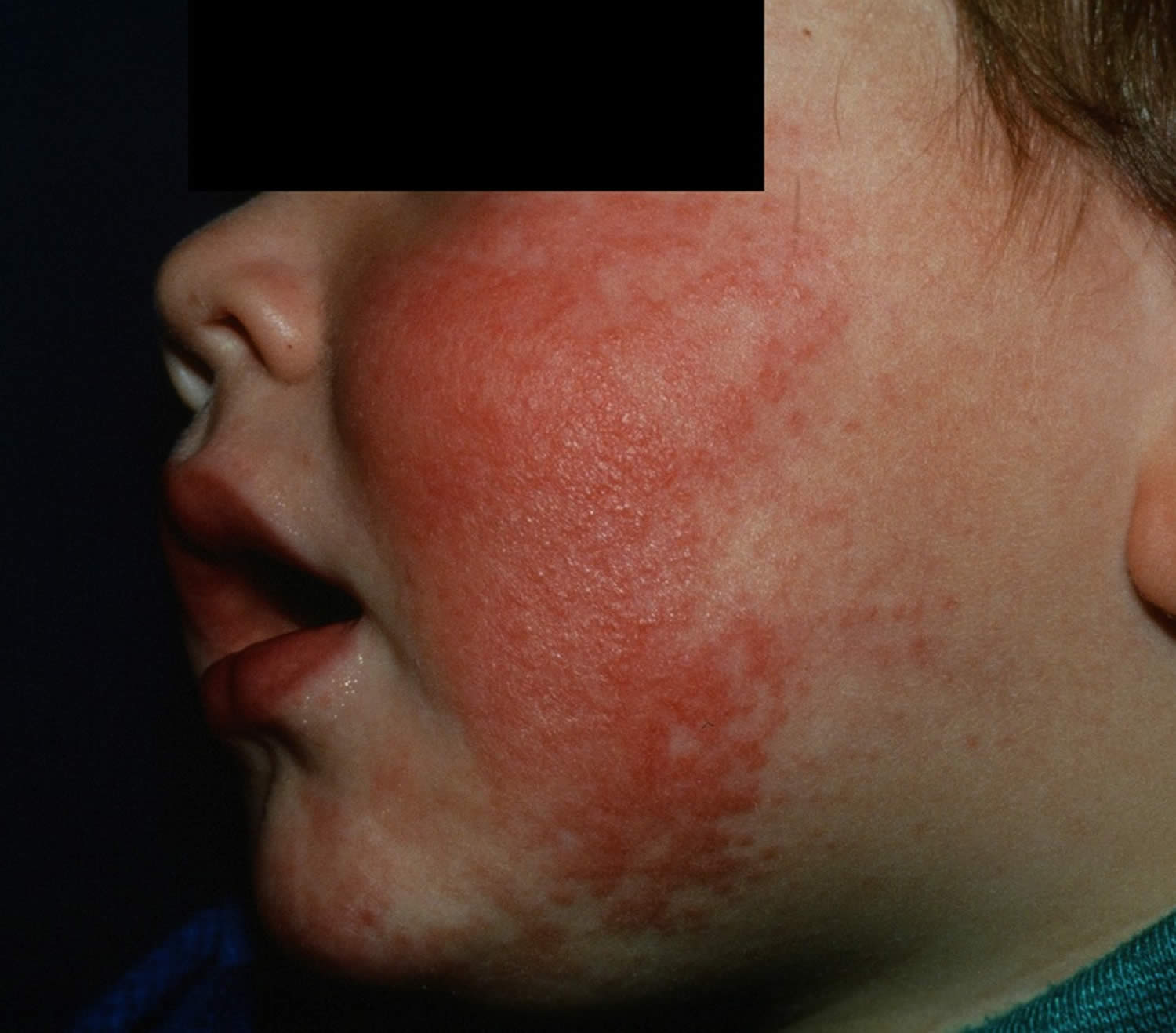 craniofacial-erythema