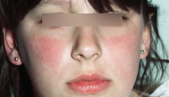 Fifth disease rash