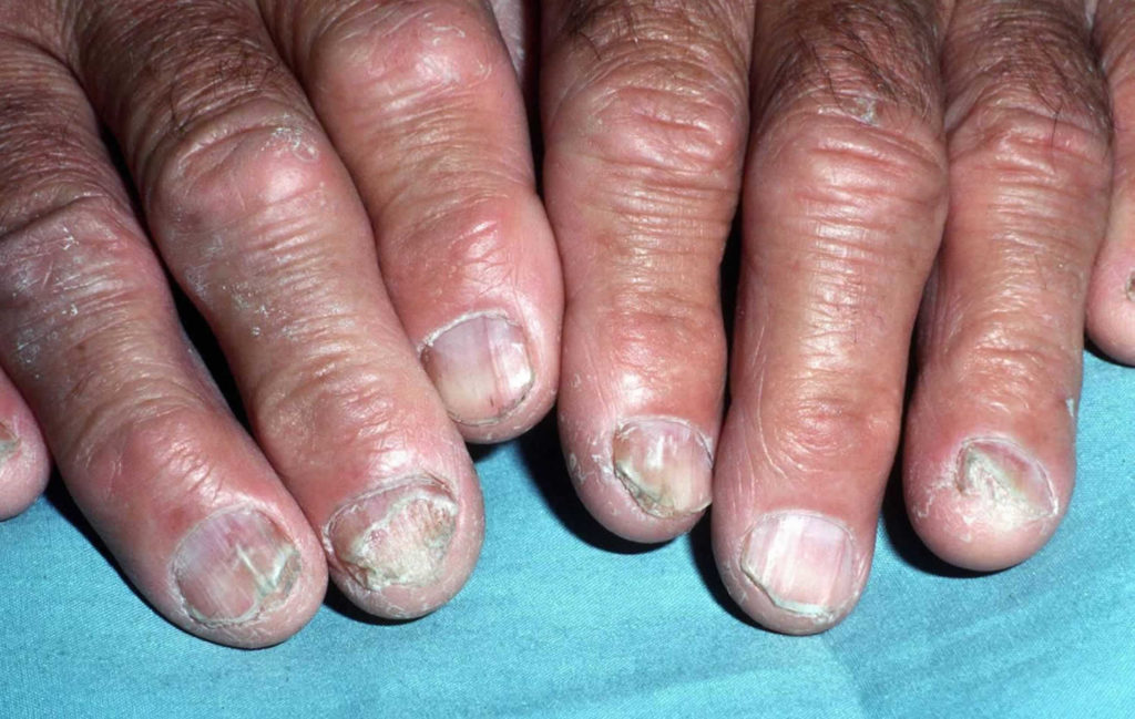 nail-fungus-infection-causes-and-how-to-get-rid-of-nail-fungus-infection