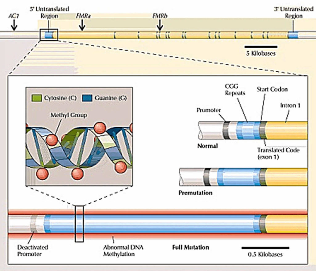 Fragile X Syndrome Causes Inheritance Symptoms Diagnosis And Treatment