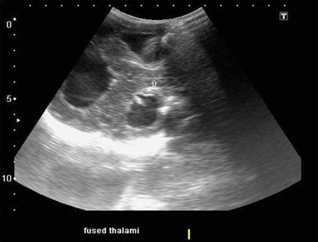 Holoprosencephaly causes, diagnosis, prognosis and treatment