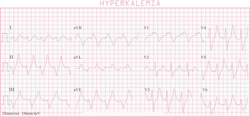 Hyperkalemia Causes Signs Symptoms Ecg Changes And Treatment